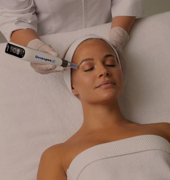 Skin_needling_treatment_airlie_beach Skin Needling